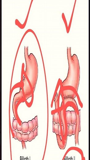 difference between billrorh 1 and Billroth II #gitpathology #anatomy #stomach #Billroth #pepticulcer