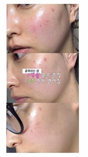7개월 묵은 흔적 붉은기 쏙 빼준 방법🚨홈케어 디바이스 오큐라 티타늄셀 4.0 후기 ¨̮