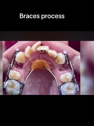 Understanding the Braces Process: What to Expect