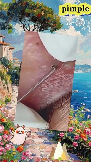 Eyebrow Pimple Extraction: A Close-Up View of Skin Care#pimpleextraction #skincare