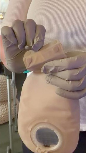 CLIP 2 of New ostomy procedure