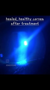 Ever heard of healing your eyes with stem cells? ✨️ Prokera and CAM 360 are FDA-cleared amniotic membranes used for healing dry eyes, corneal nerve inflammation, and corneal infections and injuries. Using stem cell therapy, it promotes cell regeneration for eye health longevity. It is known to heal the ocular surface and restore corneal integrity. The treatment takes 1-2 days, is painless, and is non-surgical. The results are improved redness, dryness, and overall corneal health. To book, call/t