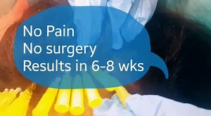 PDO threads for hair loss