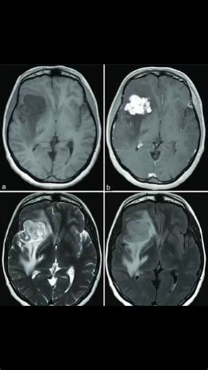 MRI Man on Instagram: "Contrast brain MRI's #mri #radiology #xray #radiologist #medicine #ctscan #radiologia #medical #radtech #ct #imaging #radiographer #xraytech #medicalimaging #radiologytech #ultrasound #xrays #healthcare #doctor #radiologylife #radiologystudent #hospital #radiography #nurse #xraystudent #medicalstudent #health #medstudent #mritech"