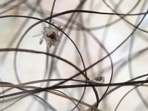 A 65-year-old man presented with a 6-week history of severe itching in the inguinal area. A crab-shaped parasite moving along a pubic hair was revealed by dermoscopy and is shown in this video. Full case details: http://nej.md/2yWnzjT | The New England Journal of Medicine