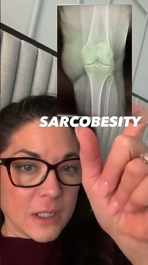 Sarcobesity: The Hidden Danger of Losing Weight Without Muscle After 40