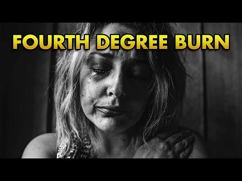 4th Degree Burn Explained