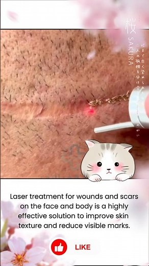 Laser treatment for facial and body scars: advanced technology for visible results #laserscarremoval