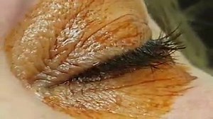87K views · 1.1K reactions | Procedure of Long lasting implant for DME in eye | I Love Medical Profession | Facebook