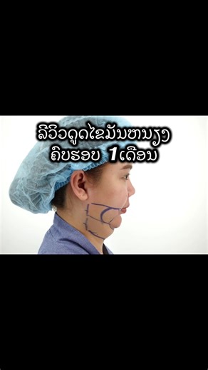 ດູດໄຂມັນຫນຽງ ຄົບຮອບ 1ເດືອນ ຄືມັນຈື້ງມາກແມ່🥰 #ດູດໄຂມັນຫນ້າຫນຽງ #ດູດໄຂມັນແກ້ມ #laferlyclinic