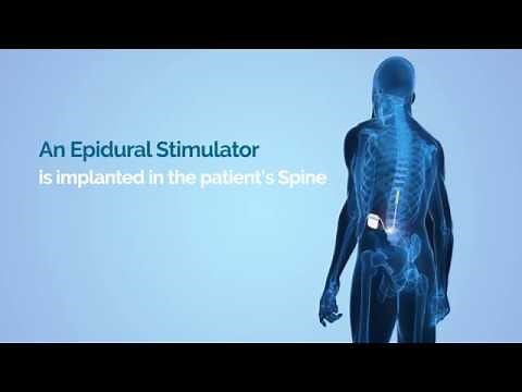 Epidural Stimulation- Breakthrough Treatment for Spinal Cord Injury