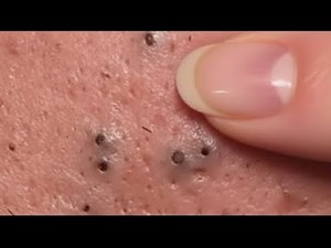 sac be spa blackhead elderly men face | sac be spa men face blackhead new 2026 | ASMR facial #asmr