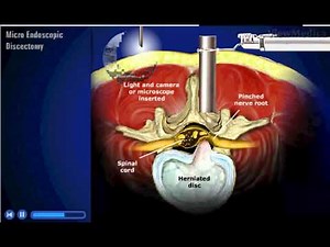 Micro Endoscopic Discectomy