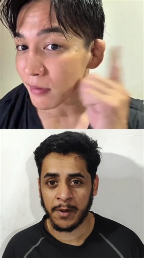 Cauliflower ears Explained