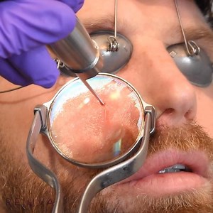 Vascular Laser for Varicose Vein Removal