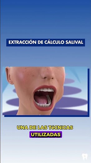 SIALOLITHIASIS - This is how salivary gland stones are PREVENTED and TREATED