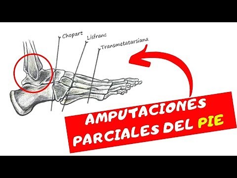 Amputaciones parciales del pie ( amputación de chopart y lisfranc)
