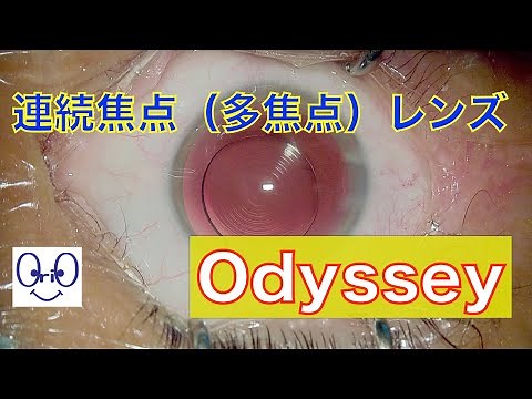 白内障手術（多焦点レンズ）Cataract surgery TECNIS Odyssey IOL