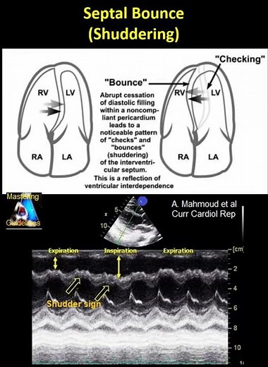 Septal Bounce (shuddering): constrictive pericarditis,... #education