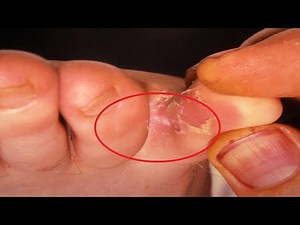 how to get rid of athlete's foot between toes