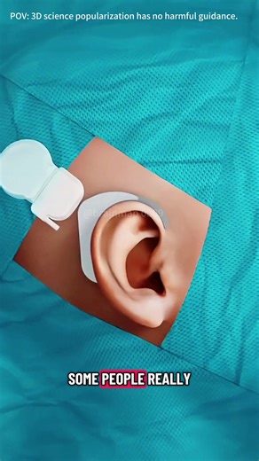 How Cochlear Implant Works? (3D Animation)#cochlearimplant #cochlearimplants #hearingloss #hearinglossprevention #hearinglossawareness #hearingaids #cochlearimplantsurgery #medical3danimation #3dmedicalanimation