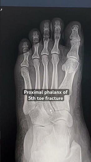 Fracture 5th toe : xray foot 🦶 #xray #xraytechnician #ctscan #mri #radiologytechnologist #neet