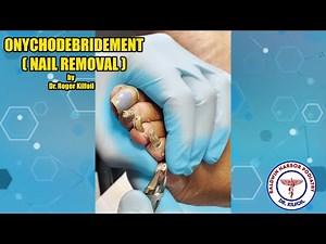 Simple Onychodebridement (Removal of Toe Nail) With Dr. Roger Kilfoil! | Podiatry Explained