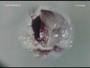 Tuberculosis Academic Film: Exploring the Void