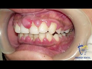 Severe gingivitis & gingival hyperplasia