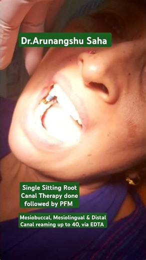 Dr.Arunangshu Saha, Root Canal Therapy of Molar teeth, Followed by Ceramic PFM, 😁✌️✌️✌️✌️✌️