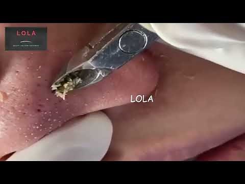 Most Relaxing, Satisfying, Enjoyable; Pluck Acne with Tweezer 06; Stress Reliever