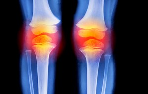 Physical Therapists Say You Need to Try These Exercises if Your Knees Crack and Pop