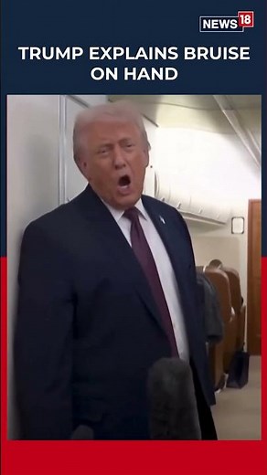 WATCH | US President Donald Trump Explains Hand Bruise, Says It’s Due to Regular Aspirin Use | N18S