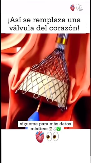 ¡Así se Remplaza una válvula del corazón! 🫀🩺 #viral #viralshort #estudiante #corazon #parati
