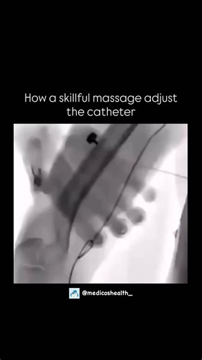 Medical & Health ⚕️ on Instagram: "Skillful massage helps adjust the catheter by massaging it towards the popliteal artery during the angiographic examination. . . . Dm for credit or removal 👏🏻 . . . #viral #bio #medical #reels #anatomy #physiology #medicalstudent #humanbody #health #stayinformed #MedicalFact #explore #reel #education #doctor #biology #study #science #mbbsstudent #mbbs #medicalfacts #knowledge #didyouknow #intrestingfacts #learning #treatment #massage"