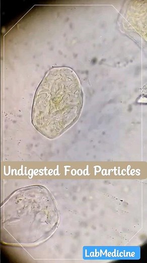Undigested Food Particles || Stool Microscopy