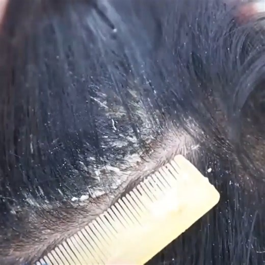 3K views · 17 reactions | Dandruff Scratching ASMR on Reels | Facebook