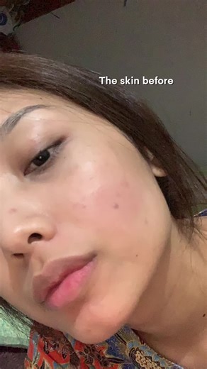 Now and then — skincare made the difference🥹✨ #commonslab #fyp #koreanskincare #SkincareRoutine #vitamincserum #skincareviral #skincare