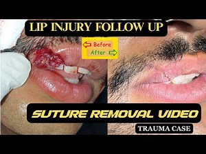 LIP INJURY SUTURE REMOVAL | LIP INJURY FOLLOW UP | LIP INJURY PRE & POST MANAGEMENT | LIP TRAUMA