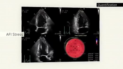 GE Vivid E95心血管彩超
