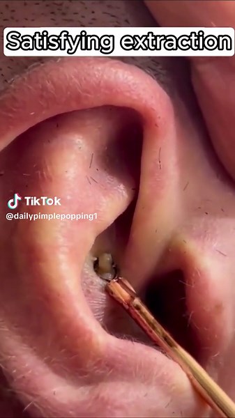 Satisfying pop #pimple #pimplepop #acne #blackhead #usa #follow TikTok