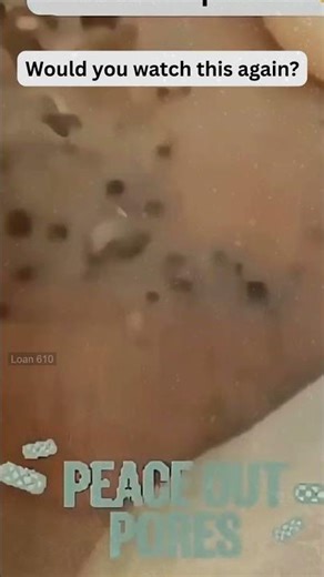 🔥Deep Blackheads, Milia & Whitehead Removal pimple popping New| Big Cystic Acne Extraction#1266 2026