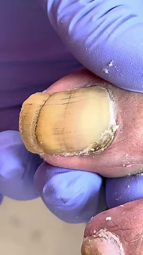 This nail had a secret locked inside AUQY #pedicure #toenail #IngrownToeNail #OddlySatisfying #fblifestyle Beautiful moments of care and relaxation through a gentle pedicure experience. Simple, clean, and satisfying. 🌿✨ Disclaimer: This video is for educational and relaxation purposes only. All content belongs to the respective owners, no copyright infringement is intended. | Foreign Cooking