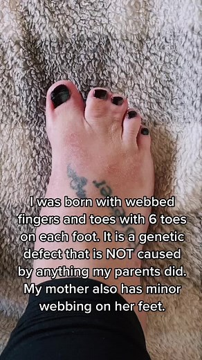 Understanding Syndactyly & Polydactyly: A Common Genetic Defect