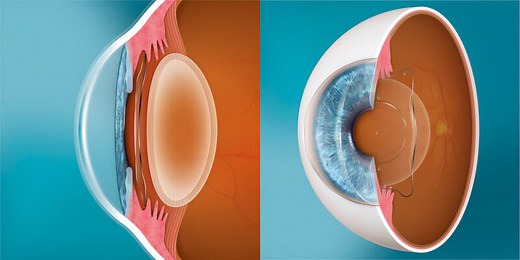 The Difference Between ICL surgery and Clear Lens Exchange