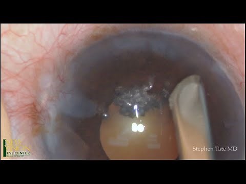 EDTA Chelation of Band Keratopathy and Cataract Extraction