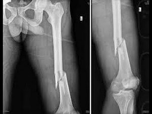PHYSIOTHERAPY Diaphyseal Fracture of the Femur with Locked Intramedullary Nail Dr. Robson Sitta C...
