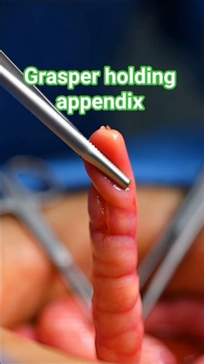 Grasper holding aappendix #appendix #health and suegery #leproscopy #viral #fouyou #appendectomy #