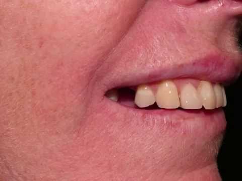 How to fix a missing tooth - The Cantilever Bridge