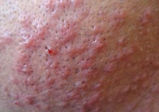 Rash on Scrotum - Sac, Inner Thigh, Shaft, Pictures, Causes, STD, Get Rid, Treatment